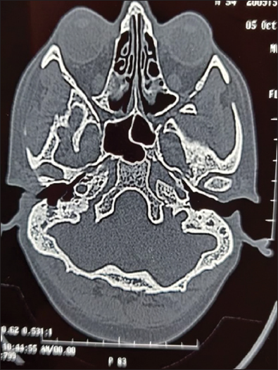 High-resolution computed tomography temporal bone axial cut showing homogenous, erosive soft tissue mass with scalloped bone in external auditory canal (EAC) occurring predominantly in inferior and posterior EAC.